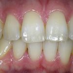 Zahnästhetik Beispiele für Ästhetische Zähne
